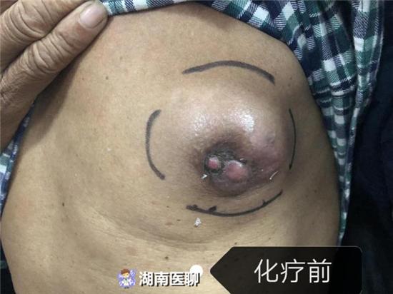 近日, 华容县人民医院乳甲胸外科就为一位乳腺癌的男性患者成功实施