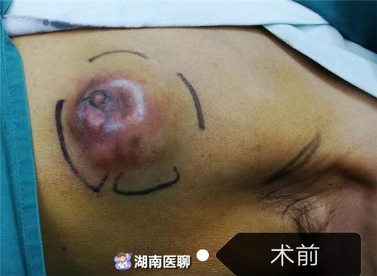 6旬大爷患乳腺癌,男人也有"胸"险!你的胸有没有这些症状?