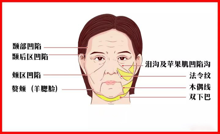 泪沟法令纹明显怎么办