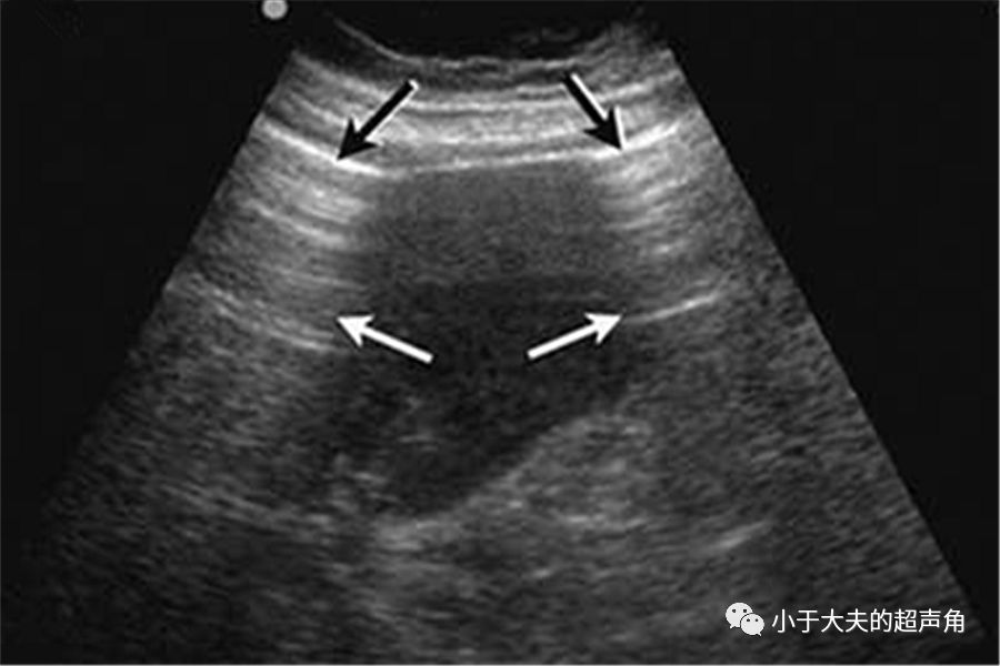 游离气体 vs  胃肠腔内气体 还是先放上正常的胃肠腔内气体的声像图