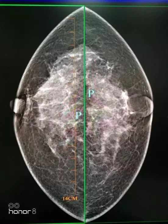 乳腺钼靶检查出钙化灶可能是患乳腺癌了