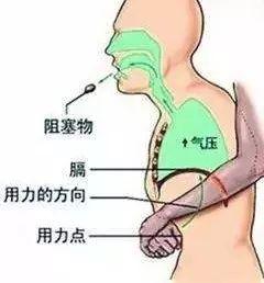 食物呛到气管怎么办