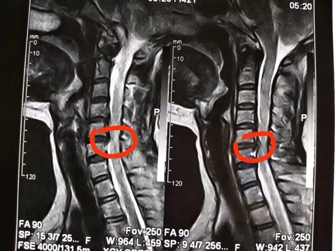 1,发育性腰椎管狭窄:  由先天性发育异常所致.