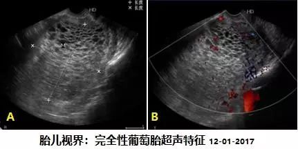 什么是葡萄胎?治疗后还可以备孕,怀孕吗?