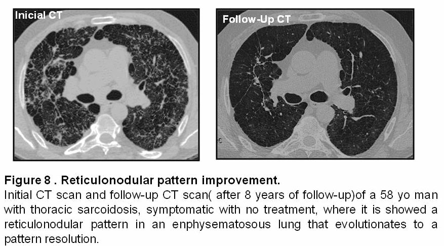 肺部结节病(pulmonary sarcoidosis)的ct表现