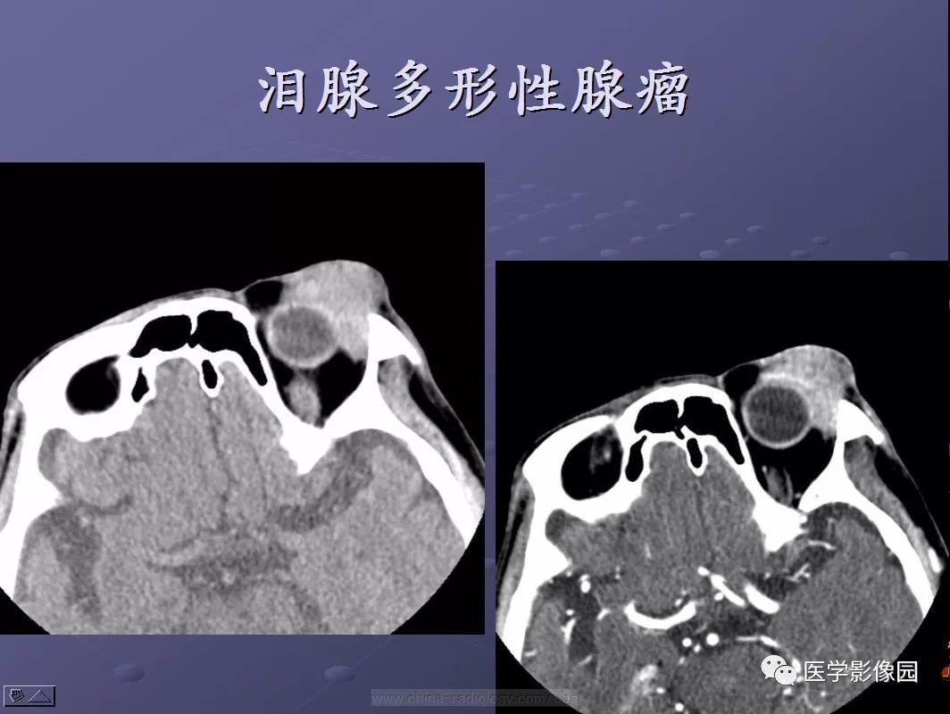 泪腺区肿块等你分析读片专栏980期