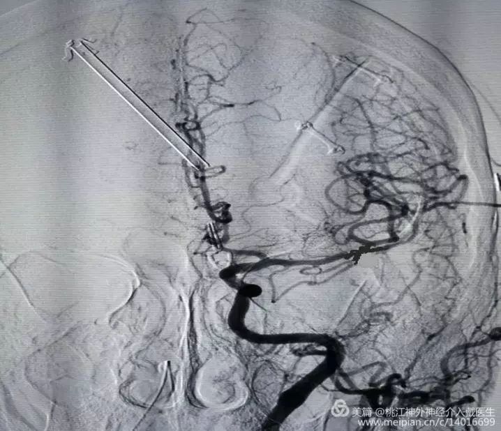 病例分享 | 一例未破裂动脉瘤导致急性脑疝的治疗体会