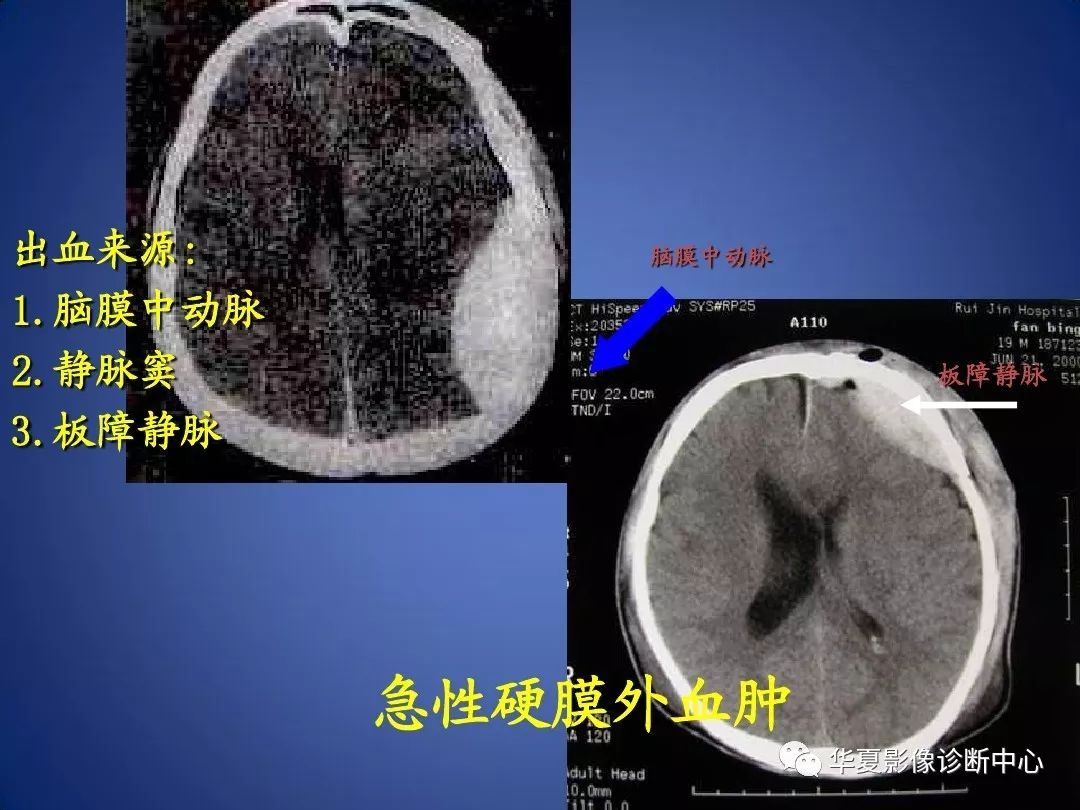 头颅外伤急诊ct诊断