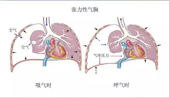 小科普:张力性气胸