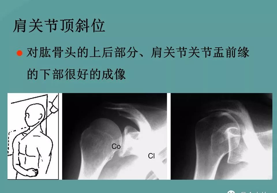 肩关节病变的影像学评估