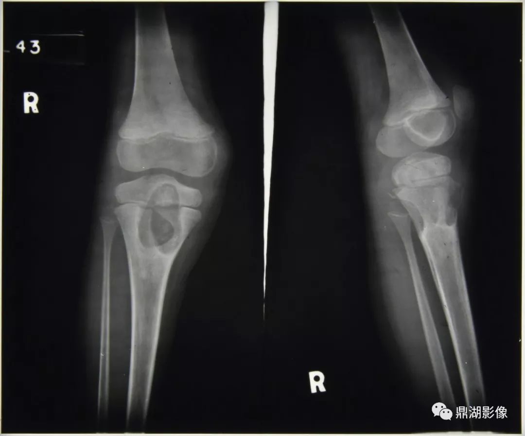 关节| 骨关节结核-msk5_骨质