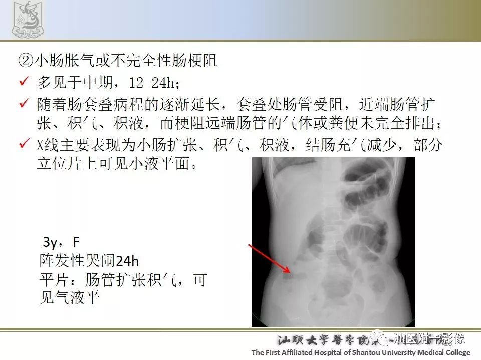 肠套叠影像学诊断