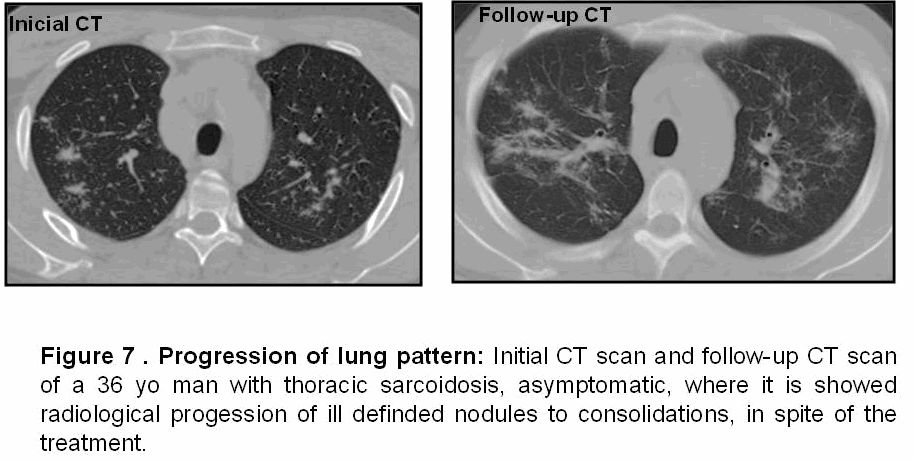 肺部结节病(pulmonary sarcoidosis)的CT表现