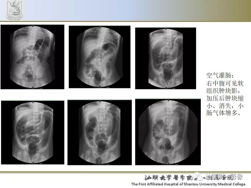 肠套叠影像学诊断