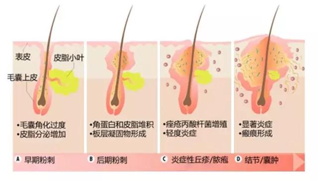 痤疮疼痒怎么办