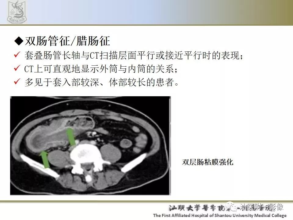 肠套叠影像学诊断