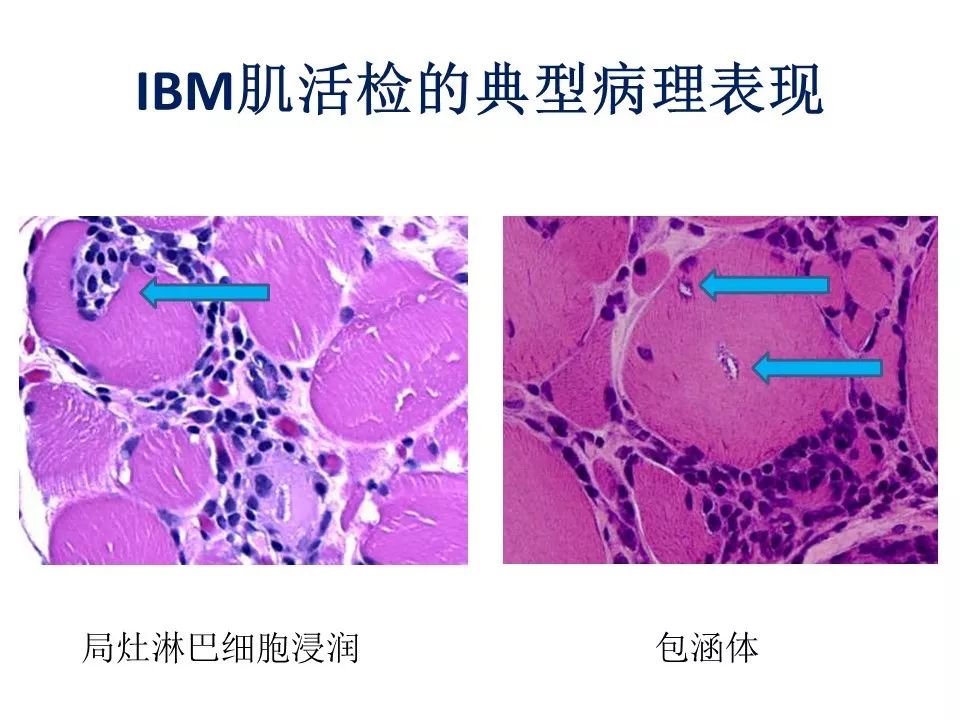 2018acr | 包涵体肌炎诊治进展!