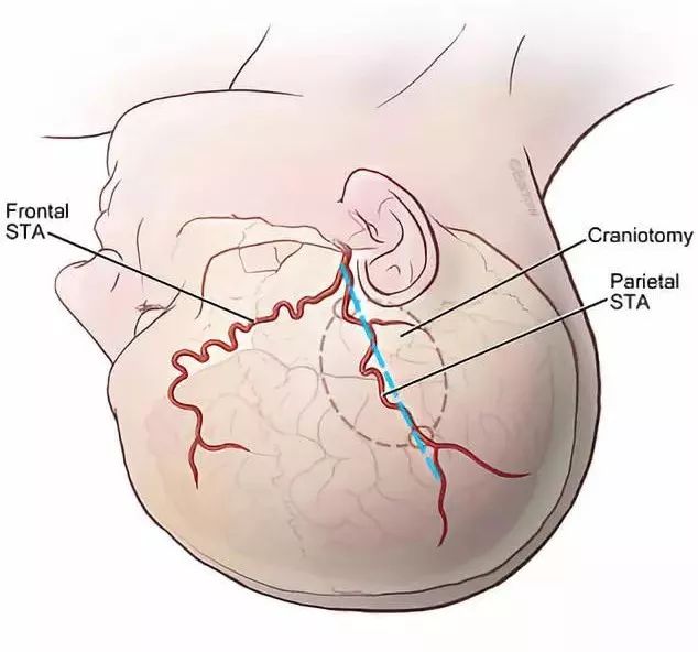nexus手术技巧丨第五期颞浅动脉stamca搭桥治疗烟雾病手术策略与技巧