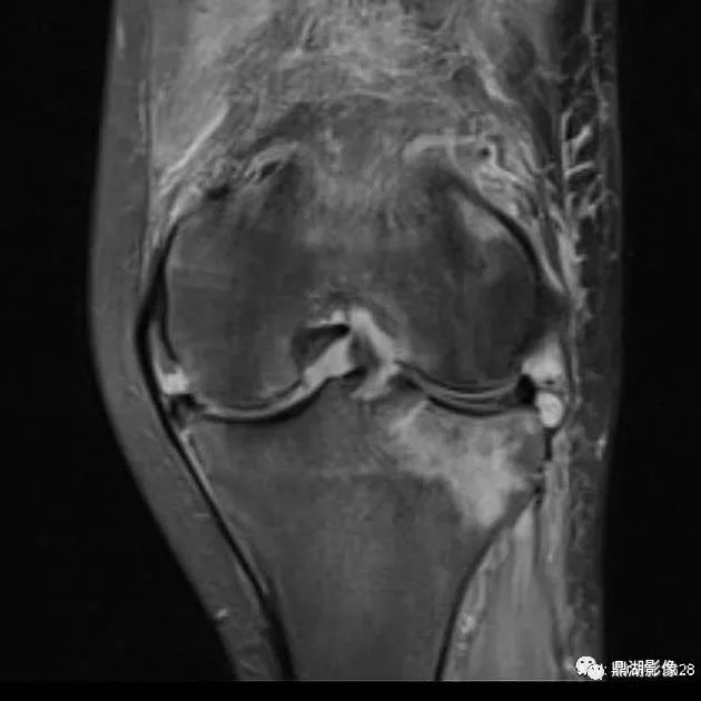 关节滑膜增生及积液:t2w1均为以高信号为主的混杂信号,t1w关节滑膜