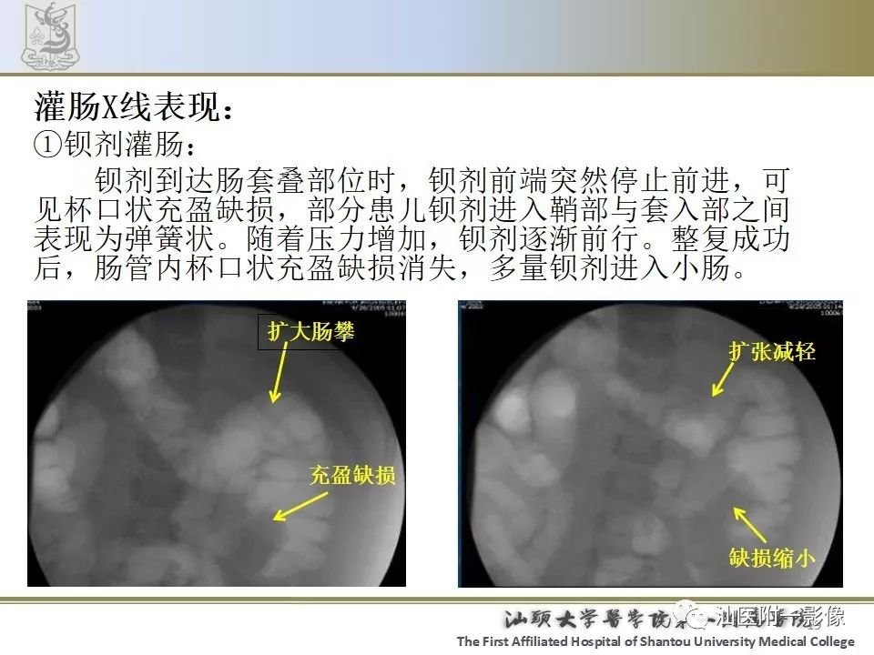 肠套叠影像学诊断