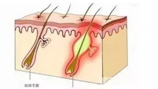 痤疮疼痒怎么办