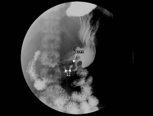 本文主讲胃部消化道造影,在下面的推荐部分还有