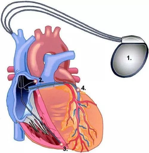 约1/3存在心脏收缩不同步,此时就需要安装 三腔起搏器,也称为 心脏再