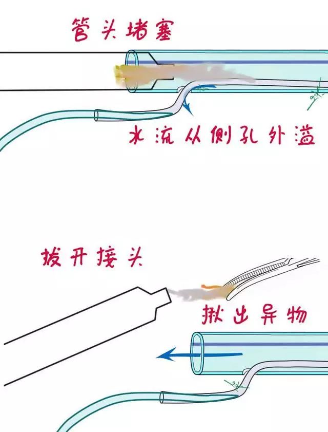 多图教你轻松搞定腹腔引流管冲洗