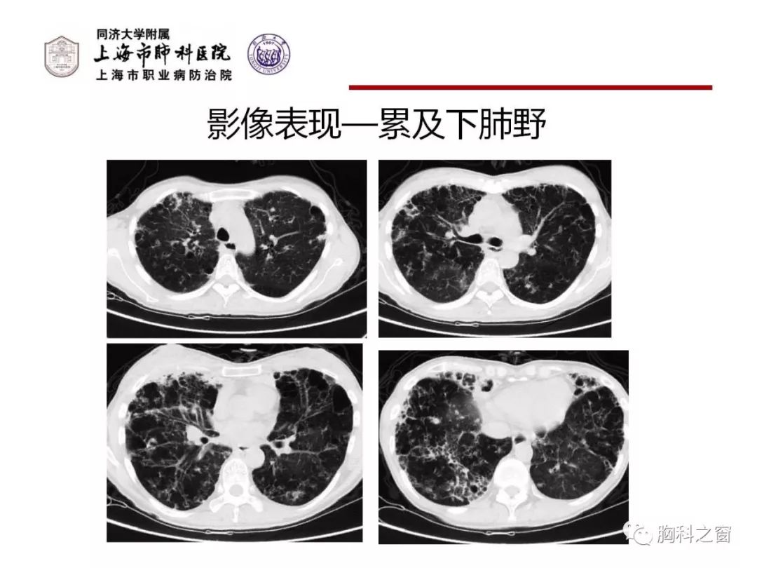 NTM肺病的诊治进展