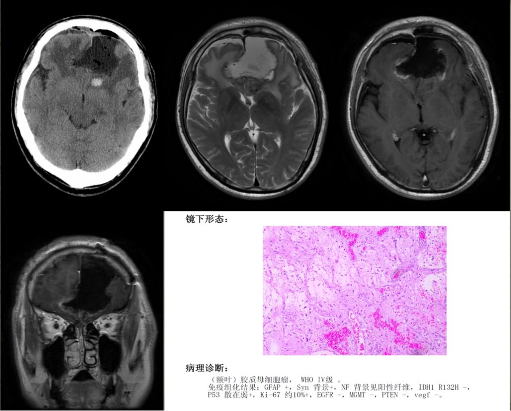 胶质母细胞瘤