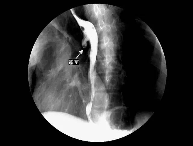 5 分钟读懂消化道造影_食管