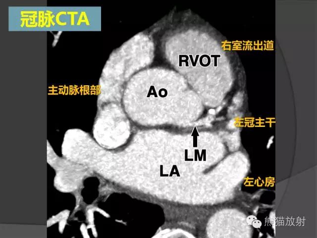 作为心血管医生必须掌握的冠脉解剖基础