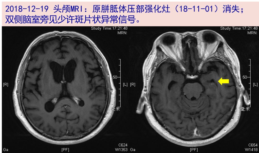 双侧脑室旁见少许斑片状异常信号;脑内少许腔隙性缺血灶;老年