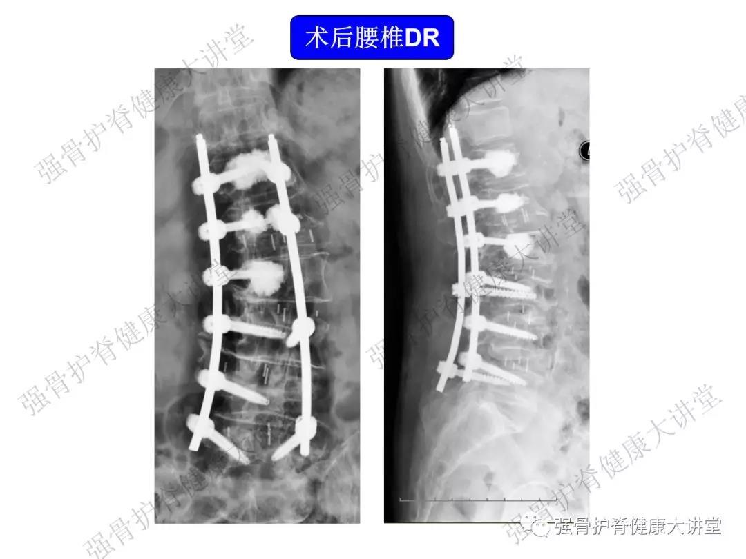 行斜外侧入路l1-5椎间盘切除,椎间植骨融合,侧弯矫形,脊髓神经根粘连