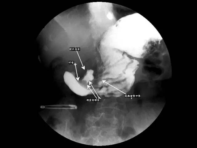 本文主讲胃部消化道造影,在下面的推荐部分还有食管篇,不