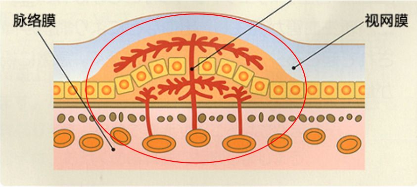 脉络膜新生血管(图片来源自网络)所以答案是:外卖真题来了!