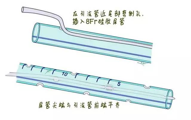 多图教你轻松搞定腹腔引流管冲洗