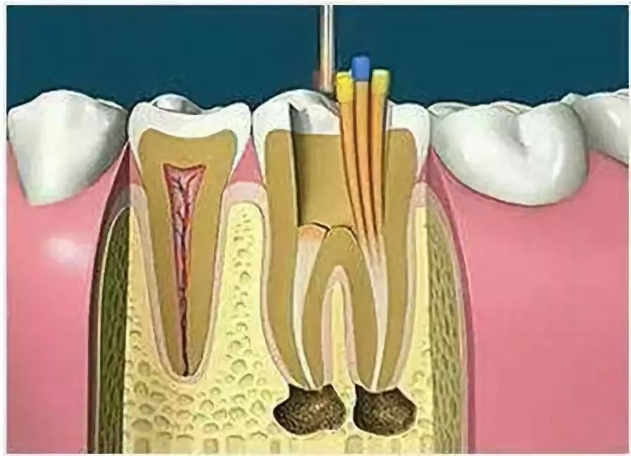 2分钟带你了解牙齿根管治疗全过程