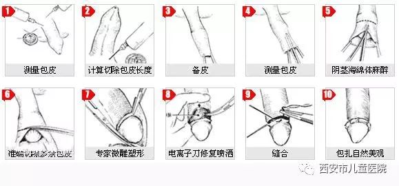 微创小手术只需十分钟 包皮大困扰烦恼去无踪