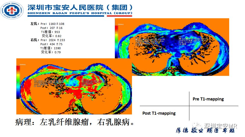 征文作品mr灌注成像与t1mapping技术在乳腺病变诊断中的应用