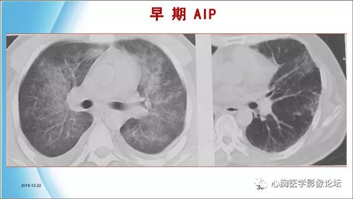 间质性肺炎的hrct诊断中国心胸医学影像论坛