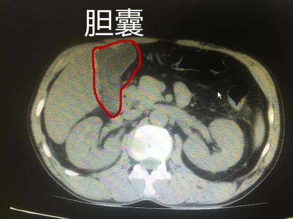 急性胆囊炎发作怎么办