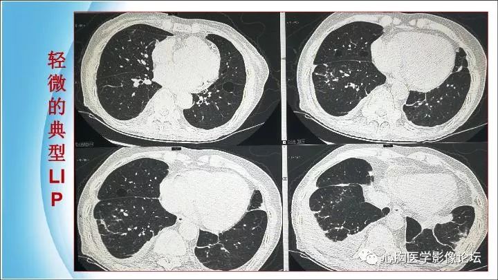 间质性肺炎的hrct诊断中国心胸医学影像论坛