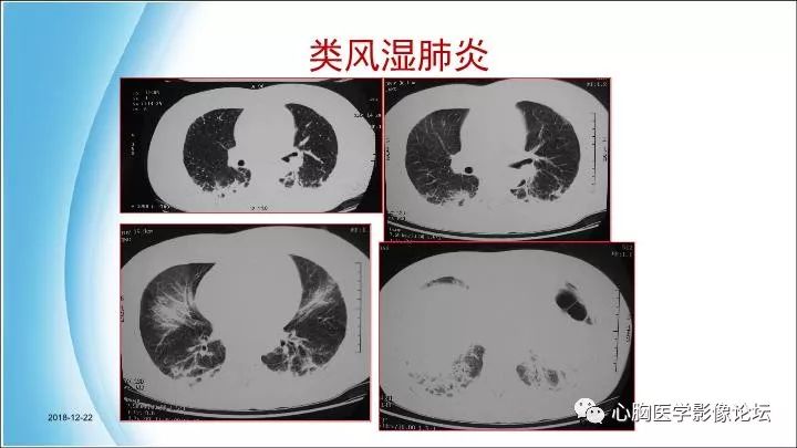 间质性肺炎的hrct诊断中国心胸医学影像论坛