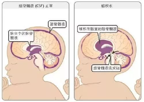 难道是脑子里面进了"水"