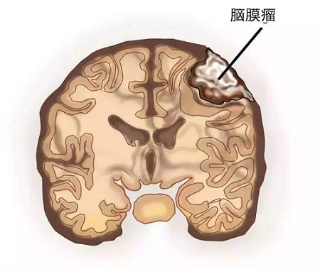 老年性脑膜瘤的症状有何特点?