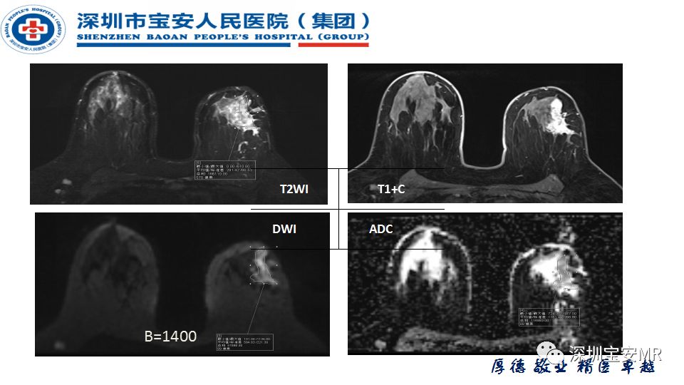 征文作品mr灌注成像与t1mapping技术在乳腺病变诊断中的应用