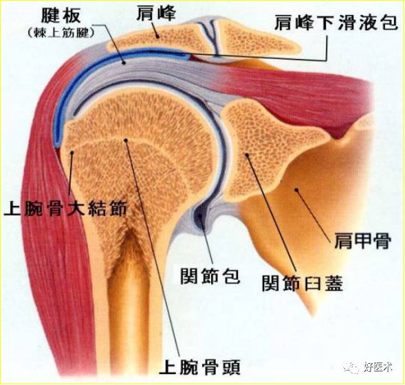 产生炎症的肩峰下滑液腔与关节腔的肌肉组织,骨粘连,粘连和疼痛限制了