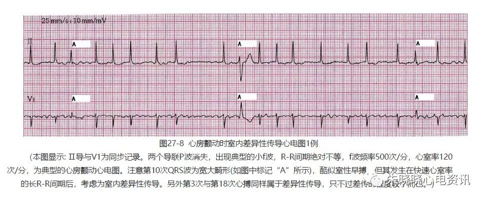 2,房颤心电图特征主要为:全部导联p波消失.