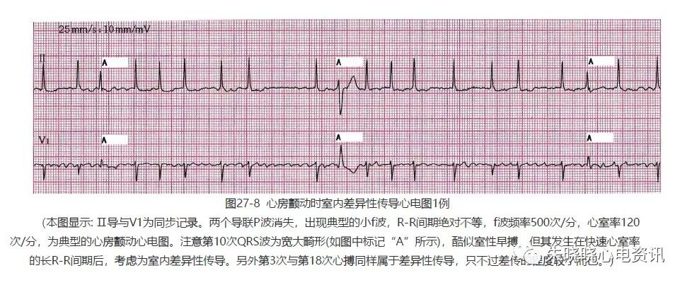 【临床实用心电图入门】 第二十七讲:心房颤动(一)